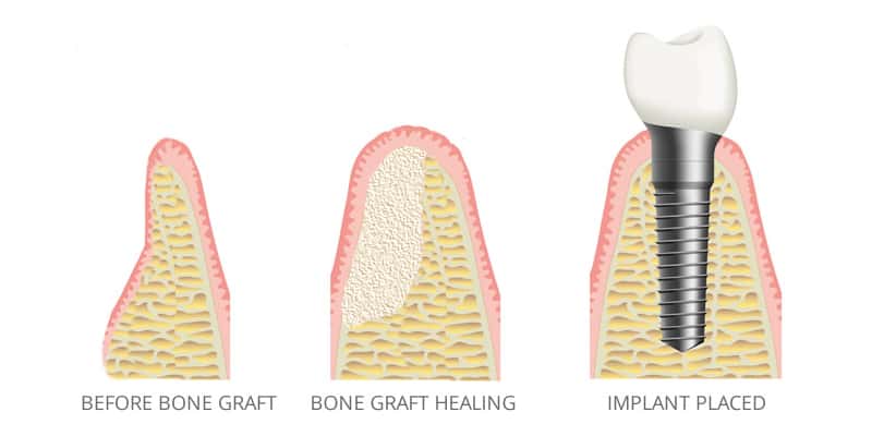 Endodontics Treatment in Oak Lawn IL