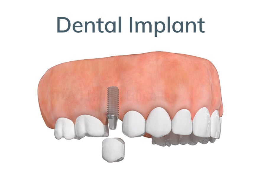 Dental Implants