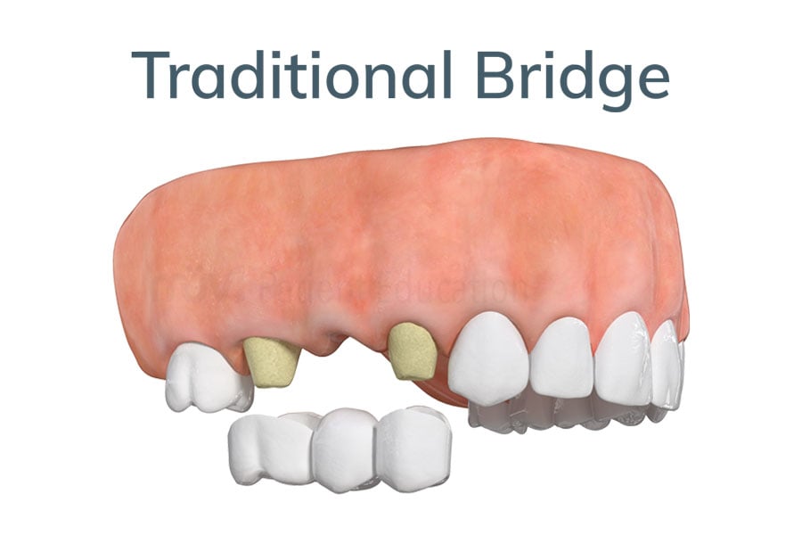 Dental Bridge